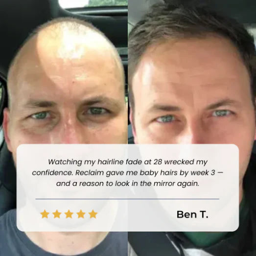 UpFollicle Advanced Hair Growth Roll-On Serum